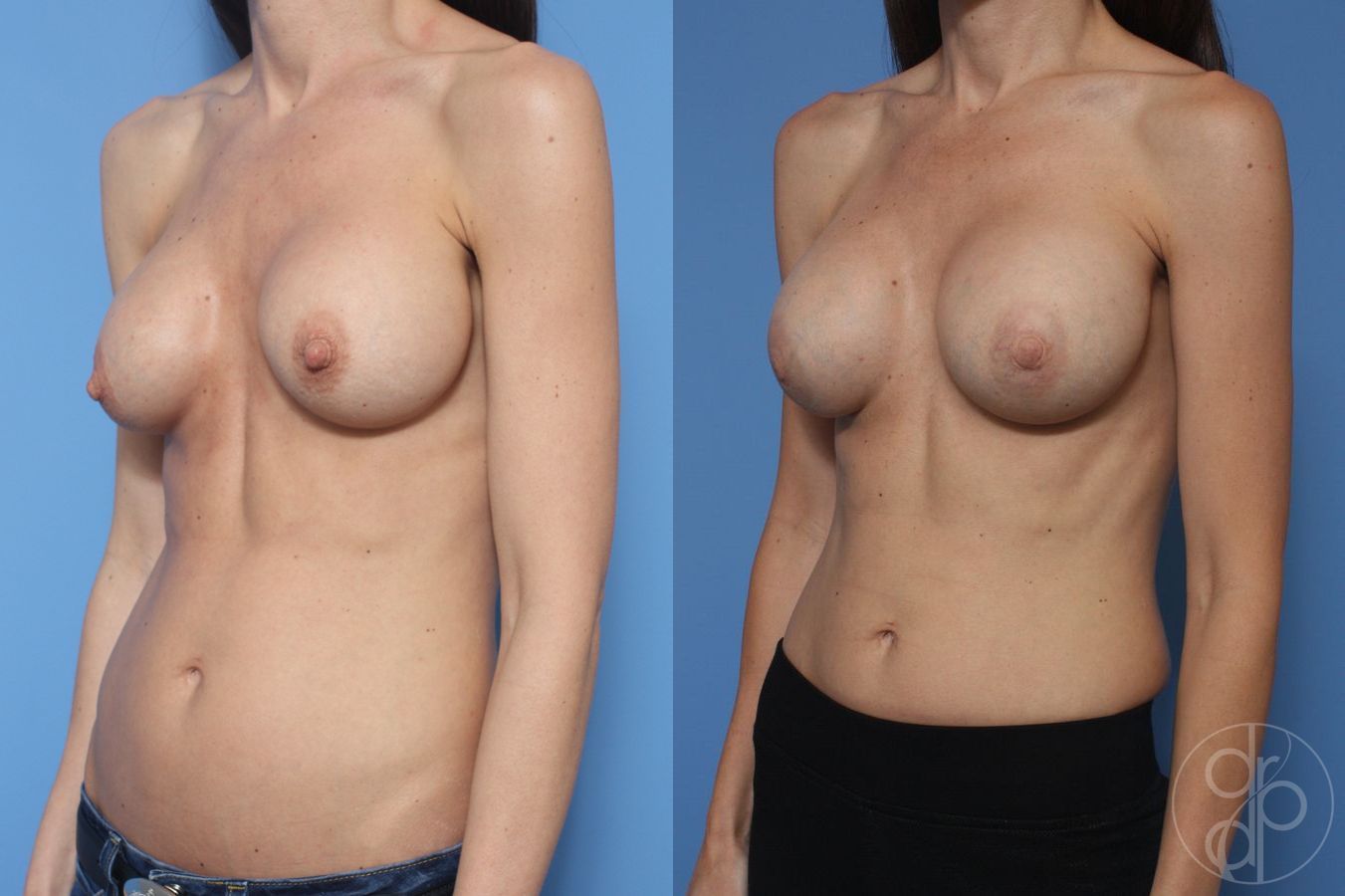 Before and after Remove & Replace case 29859 - Angle 2