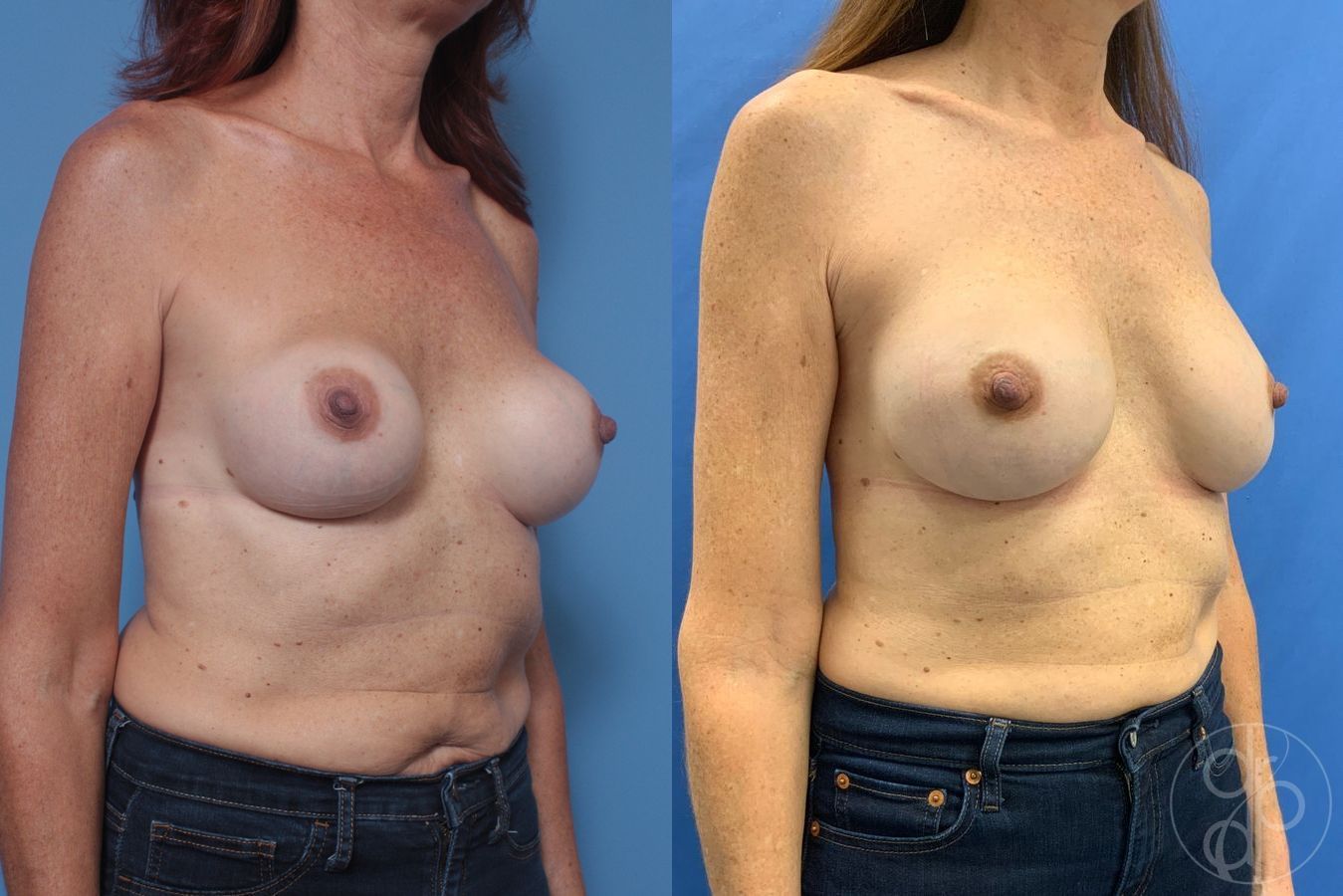 Remove & Replace - Thumbnail 2