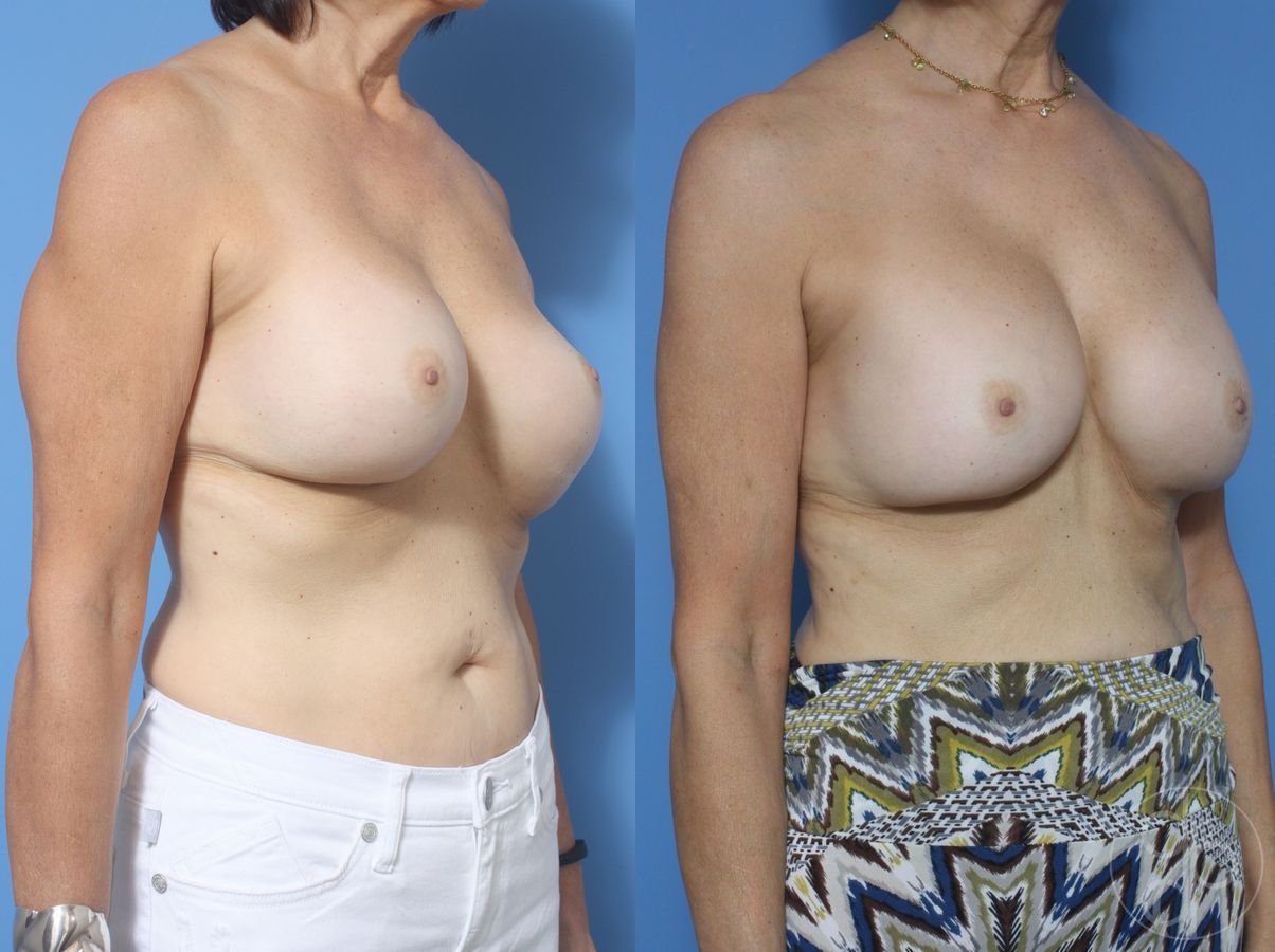 Before and after Remove & Replace case 29851 - Angle 2