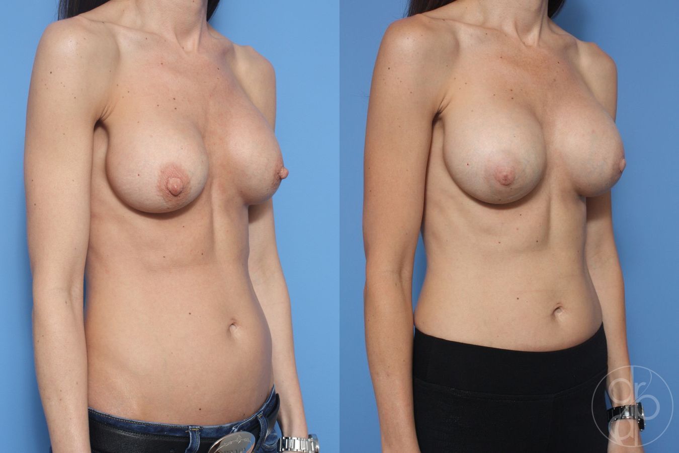Before and after Remove & Replace case 29859 - Angle 3