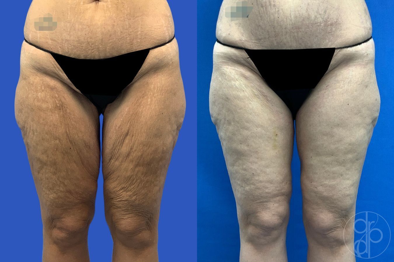 Before and after Thigh Lift case 46415