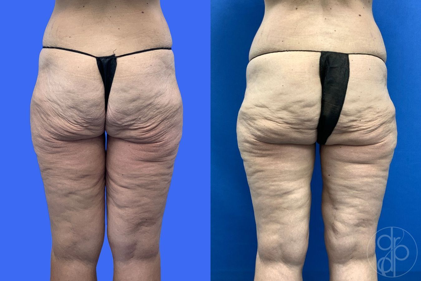 Before and after Thigh Lift case 46415 - Angle 5