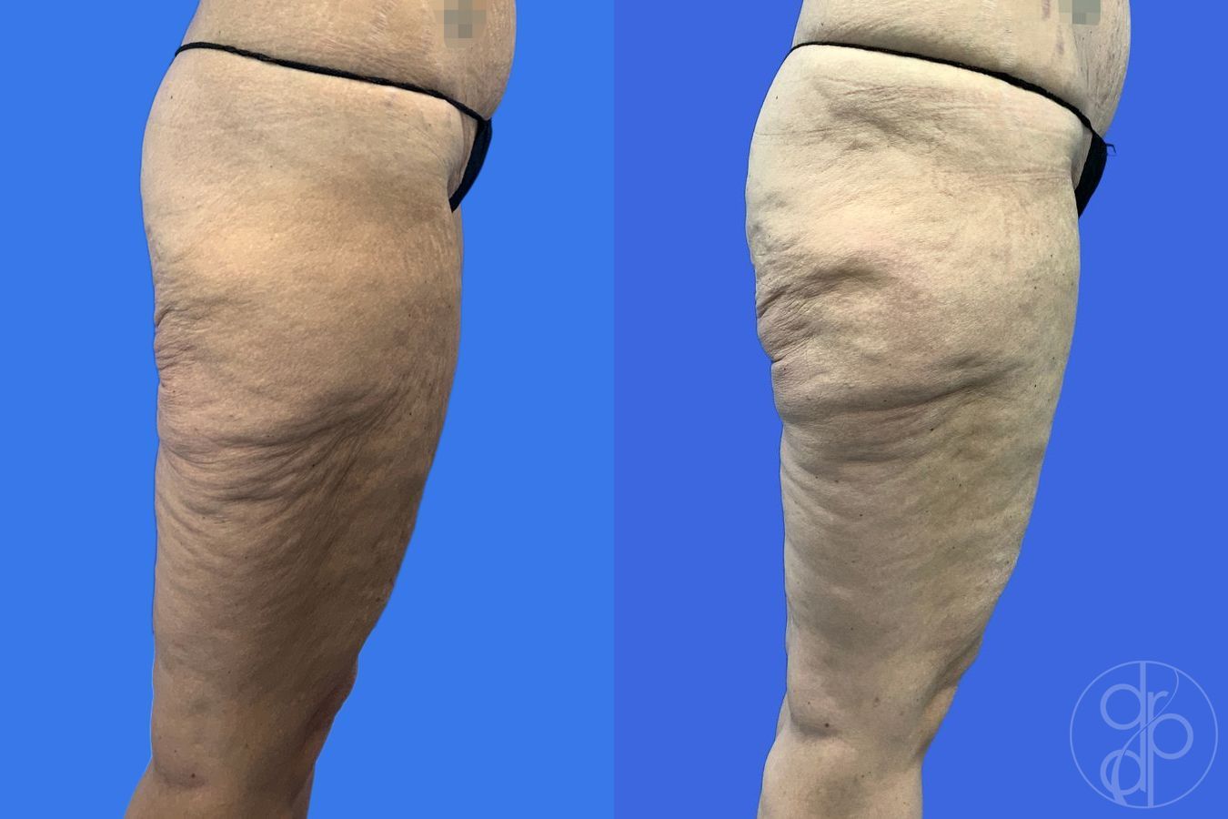 Before and after Thigh Lift case 46415 - Angle 3