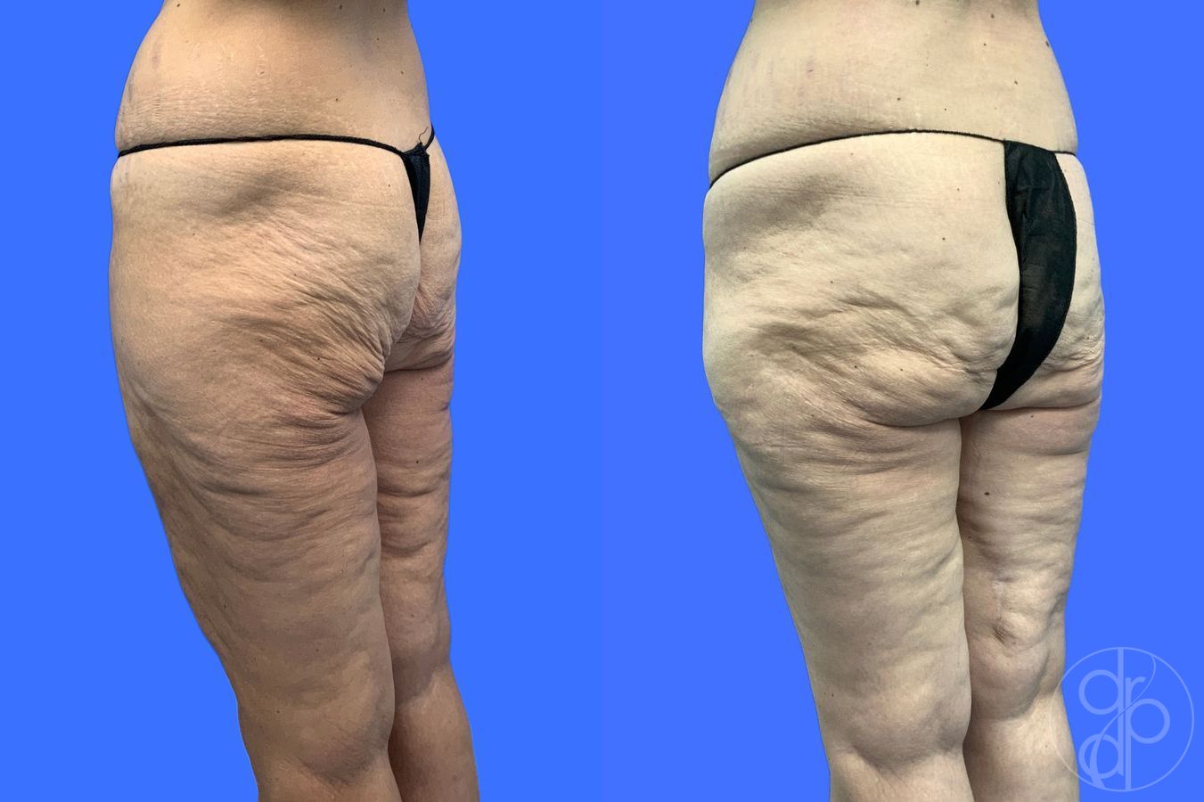 Before and after Thigh Lift case 46415 - Angle 6