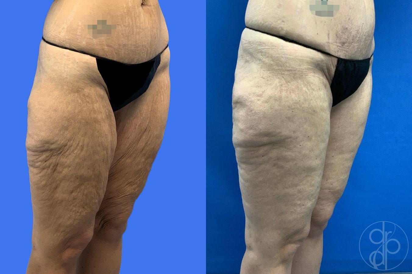 Before and after Thigh Lift case 46415 - Angle 2