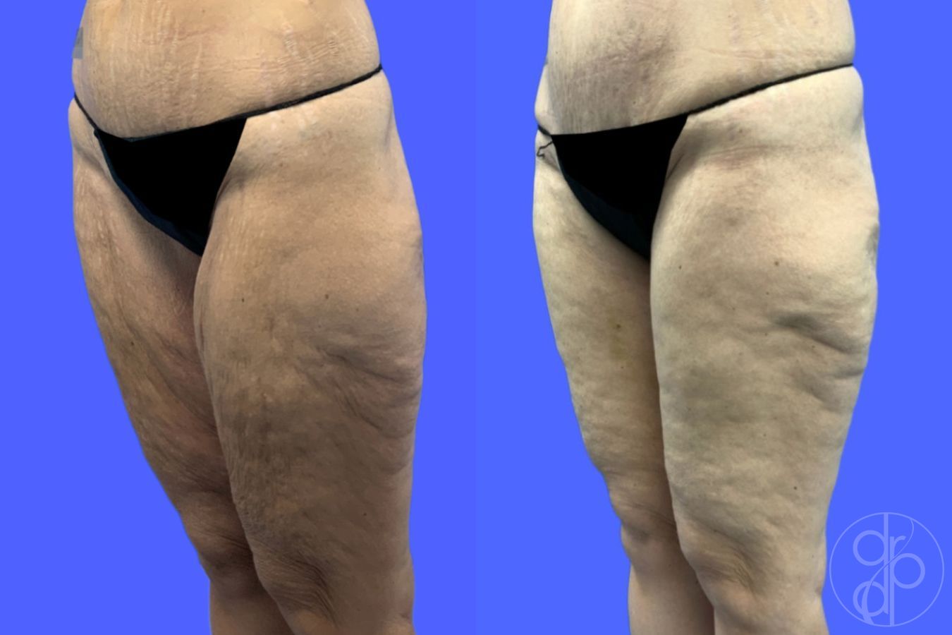 Before and after Thigh Lift case 46415 - Angle 8