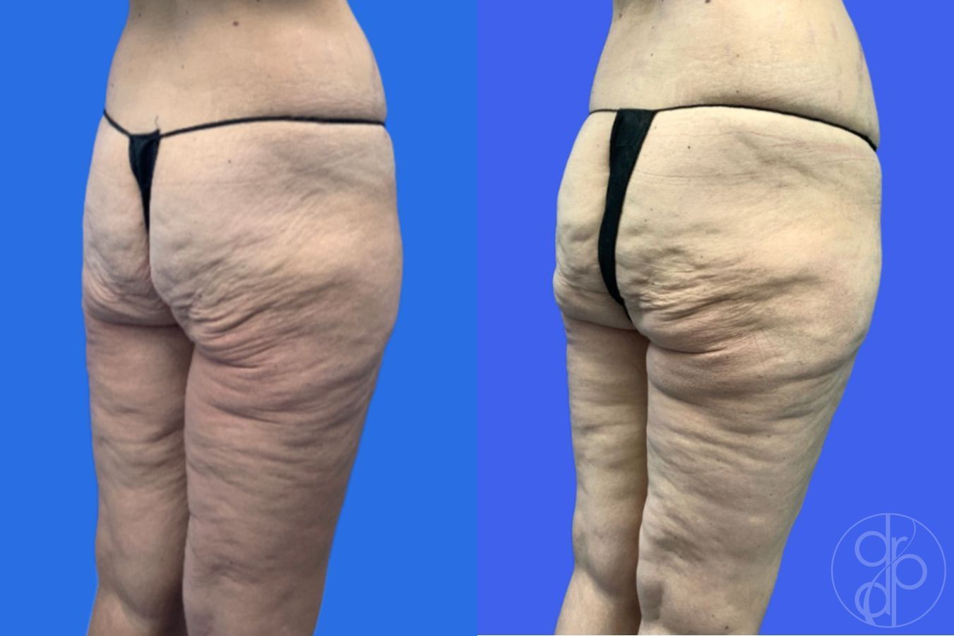 Before and after Thigh Lift case 46415 - Angle 4