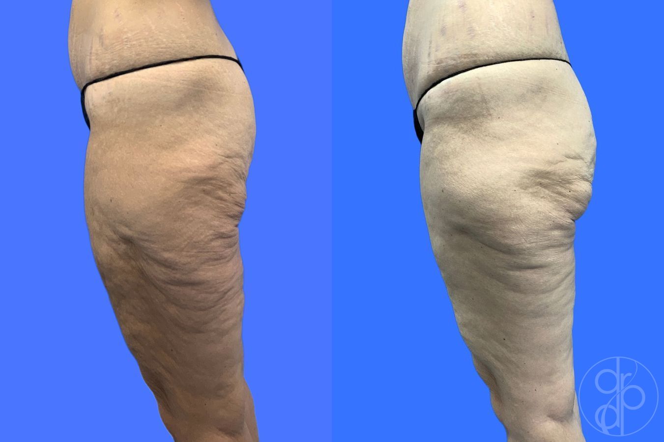 Before and after Thigh Lift case 46415 - Angle 7