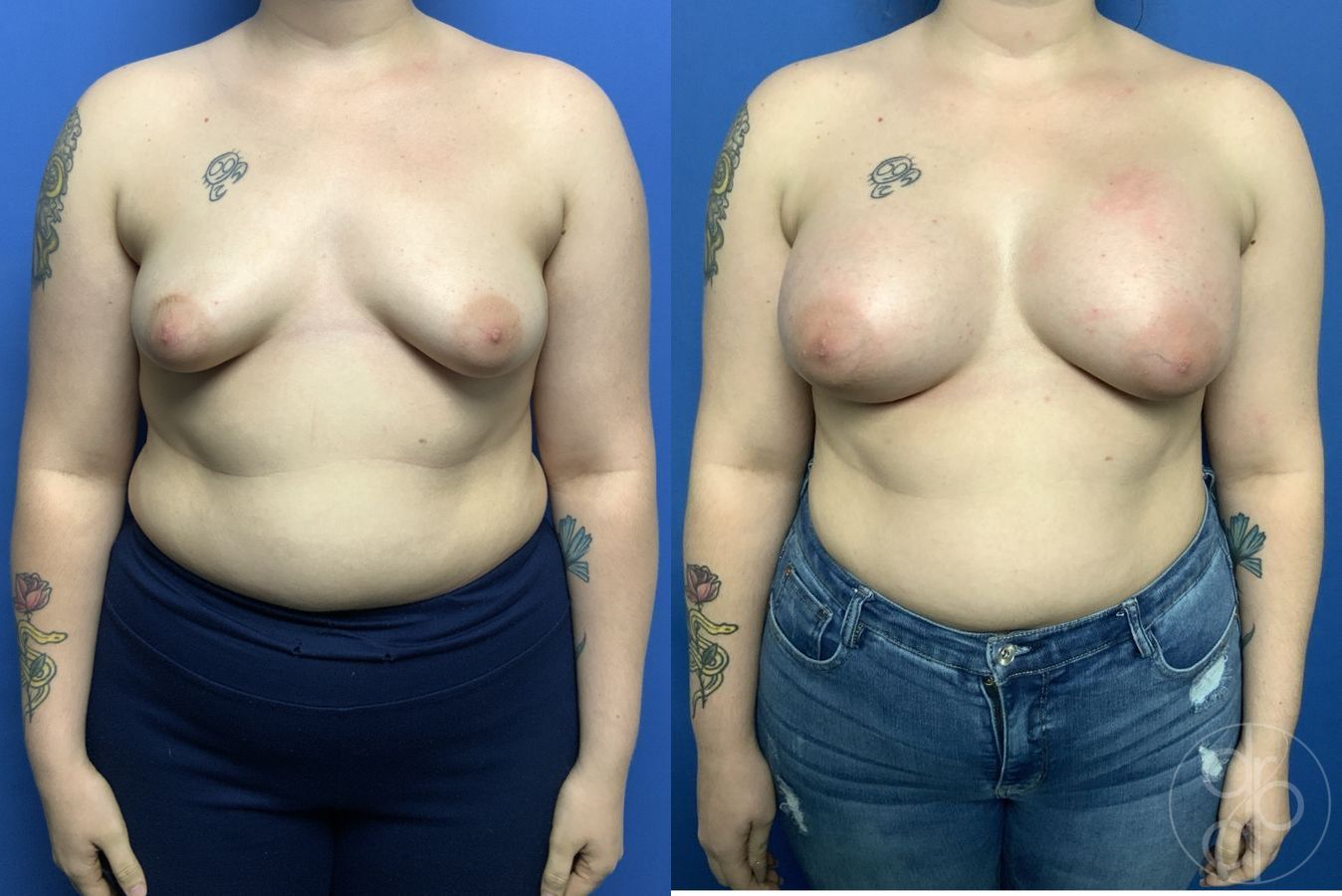 Before and after Tubular Breast Surgery case 29839