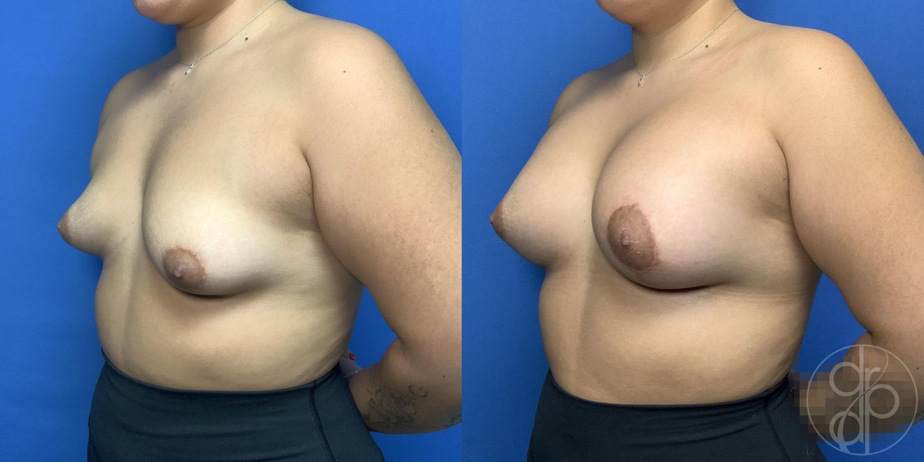 Before and after Tubular Breast Surgery case 29990 - Angle 3