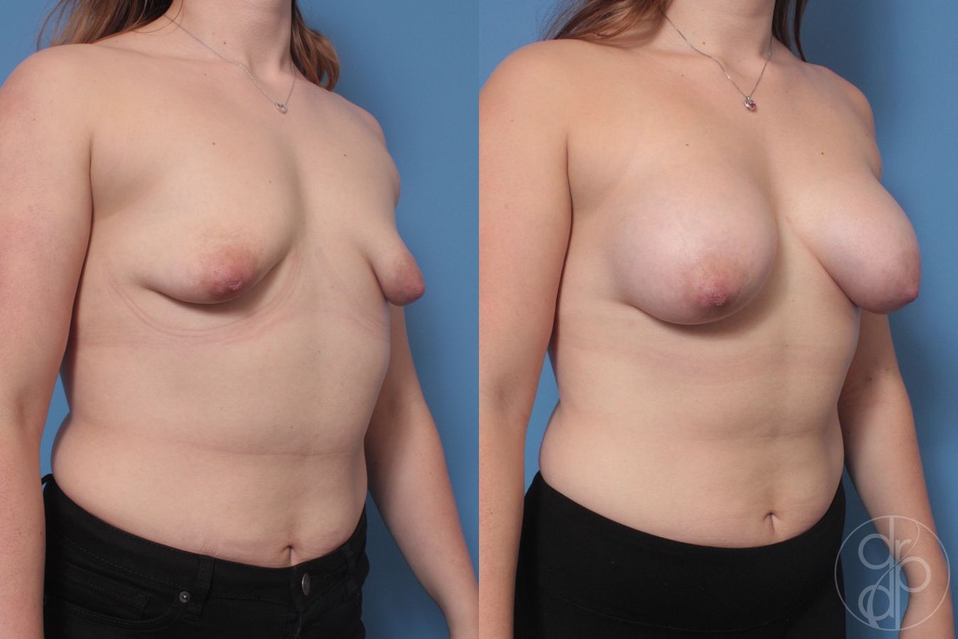Before and after Tubular Breast Surgery case 29906 - Angle 3
