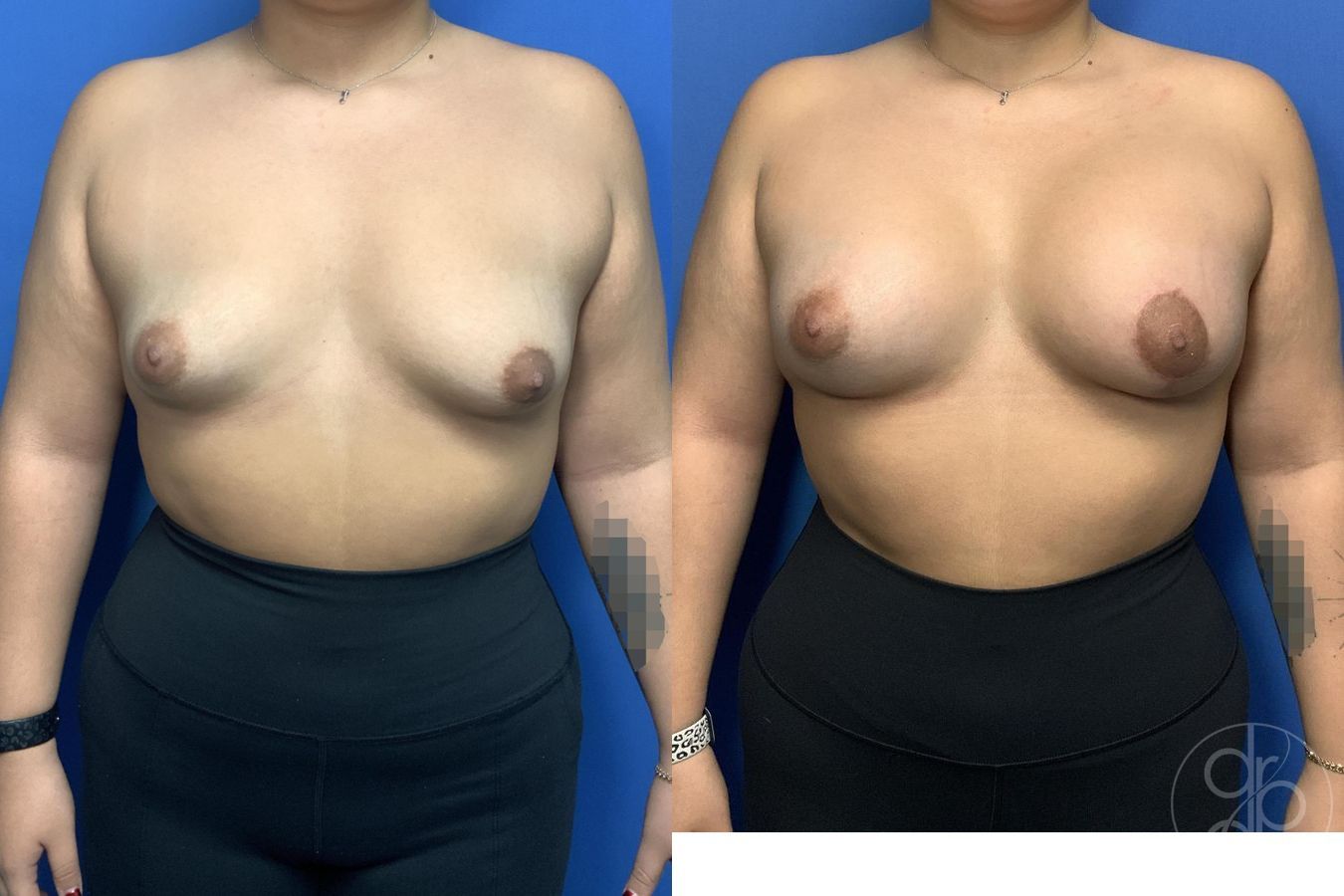 Before and after Tubular Breast Surgery case 29990