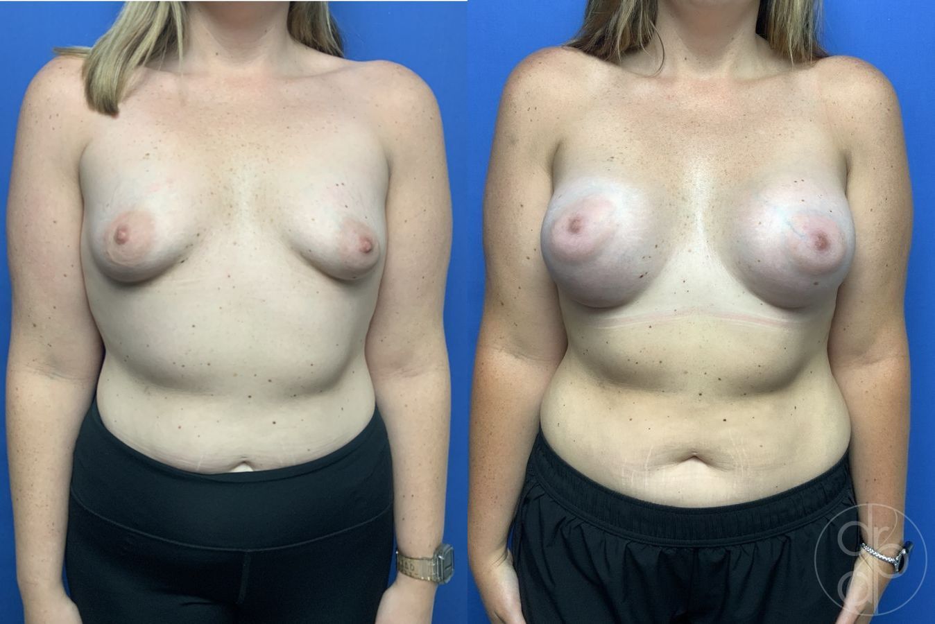 Before and after Tubular Breast Surgery case 29970