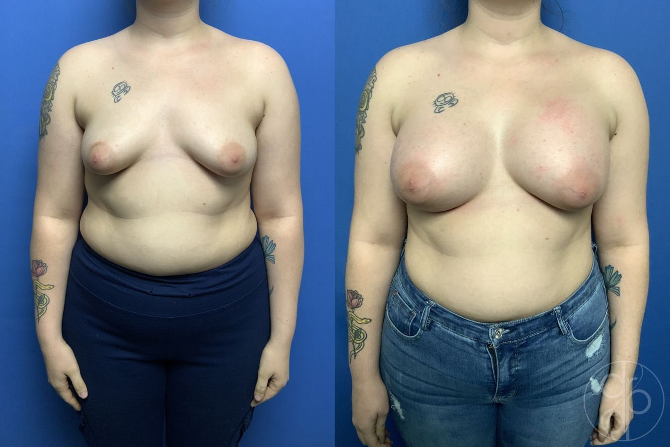 Before and after Tubular Breast Surgery case 29839