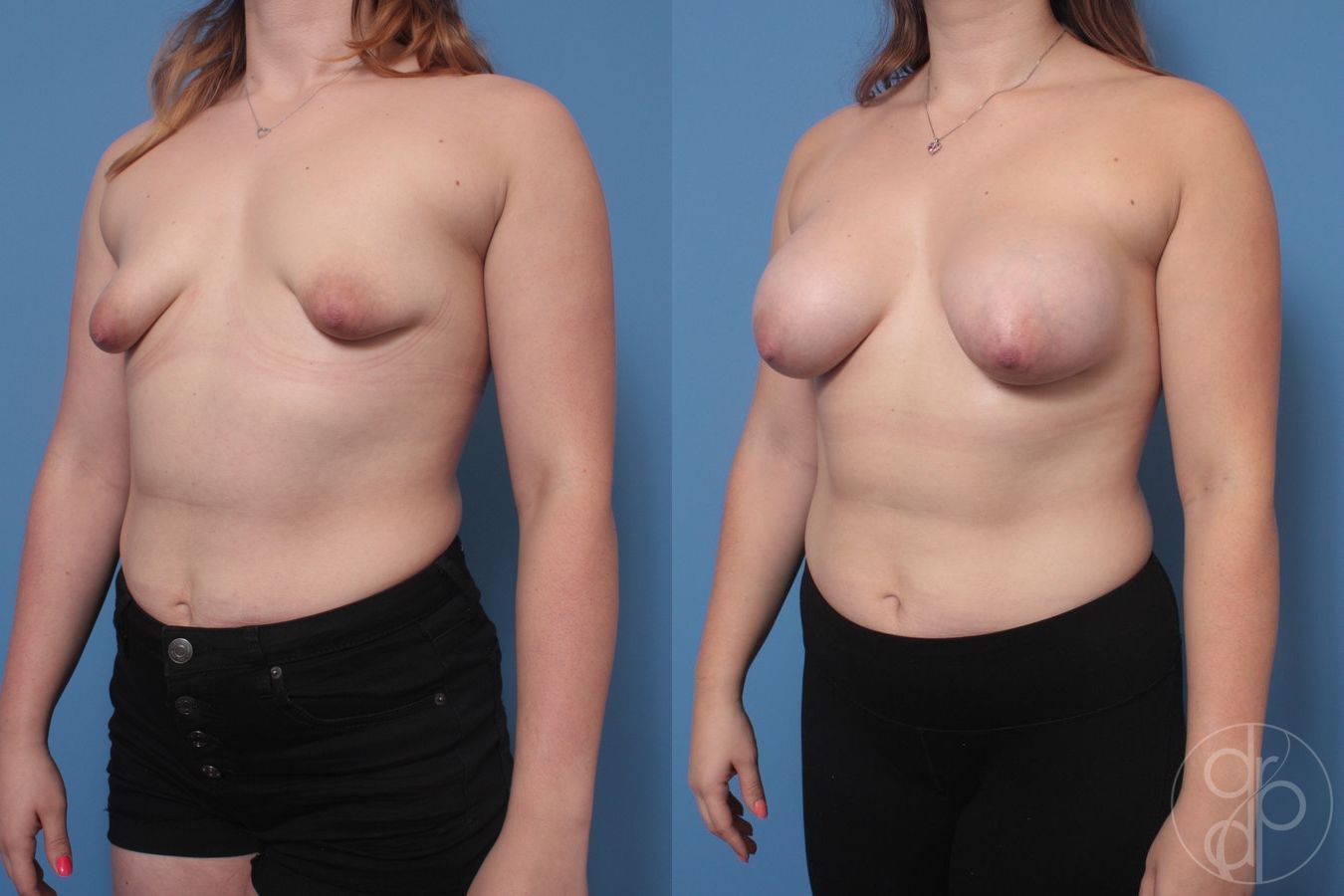 Before and after Tubular Breast Surgery case 29906 - Angle 2