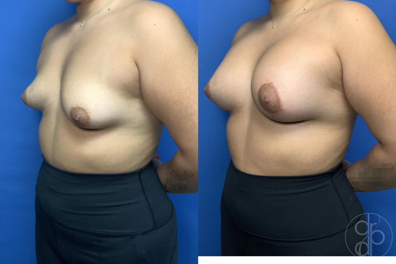 Before and after Tubular Breast Surgery case 29990 - Angle 3