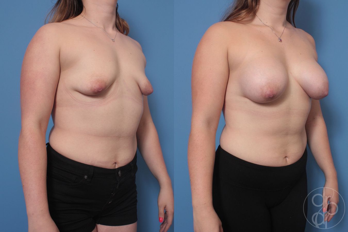 Before and after Tubular Breast Surgery case 29906 - Angle 3