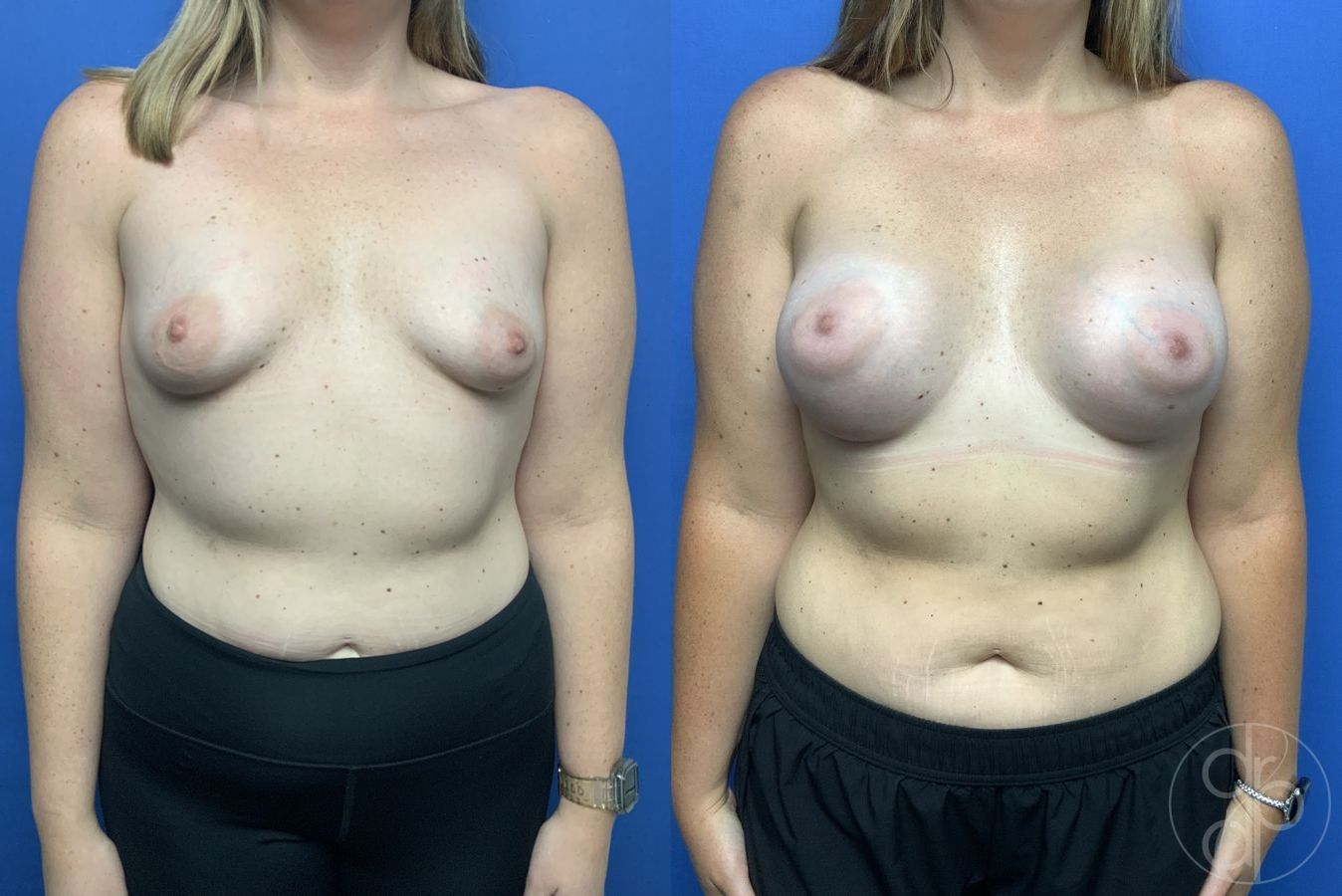 Before and after Tubular Breast Surgery case 29970