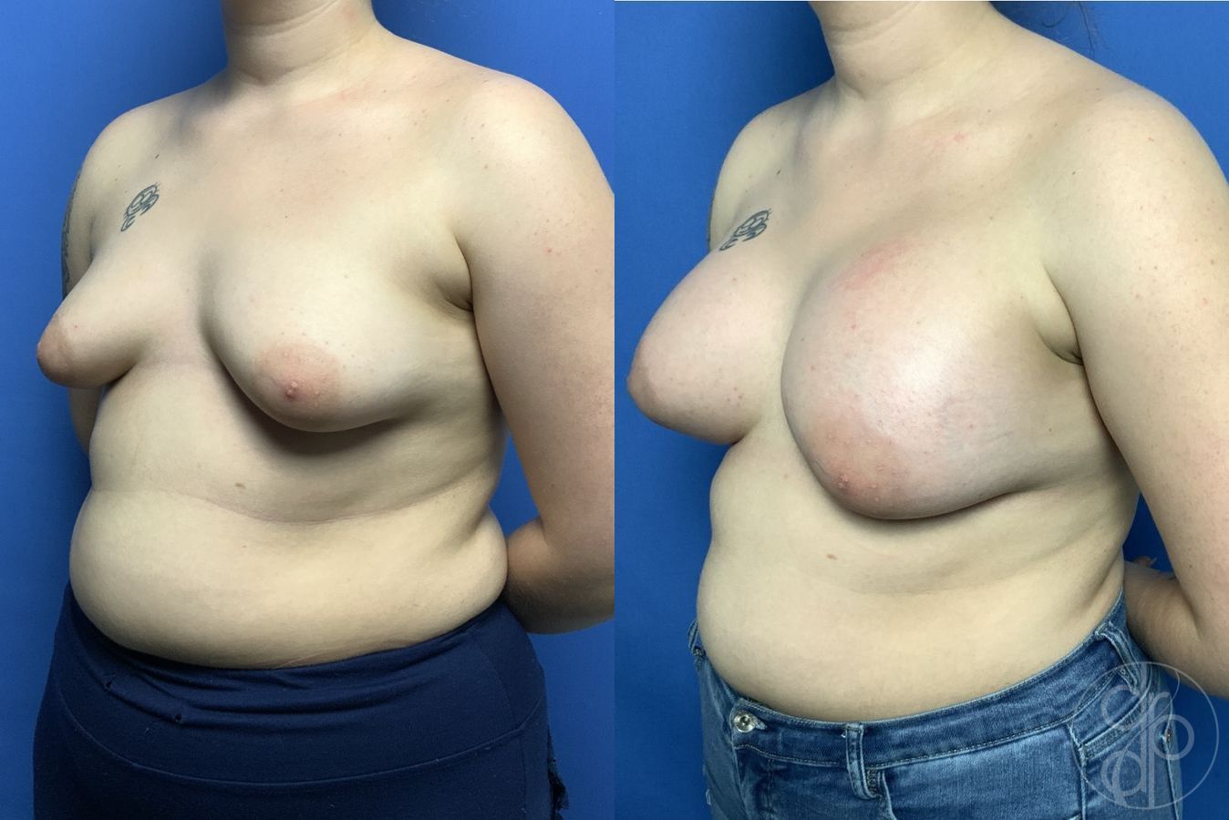 Before and after Tubular Breast Surgery case 29839 - Angle 3