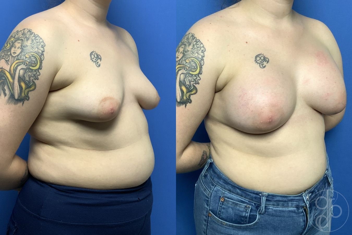 Before and after Tubular Breast Surgery case 29839 - Angle 2