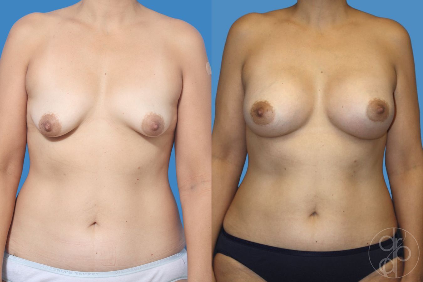 Before and after Tubular Breast Surgery case 29912