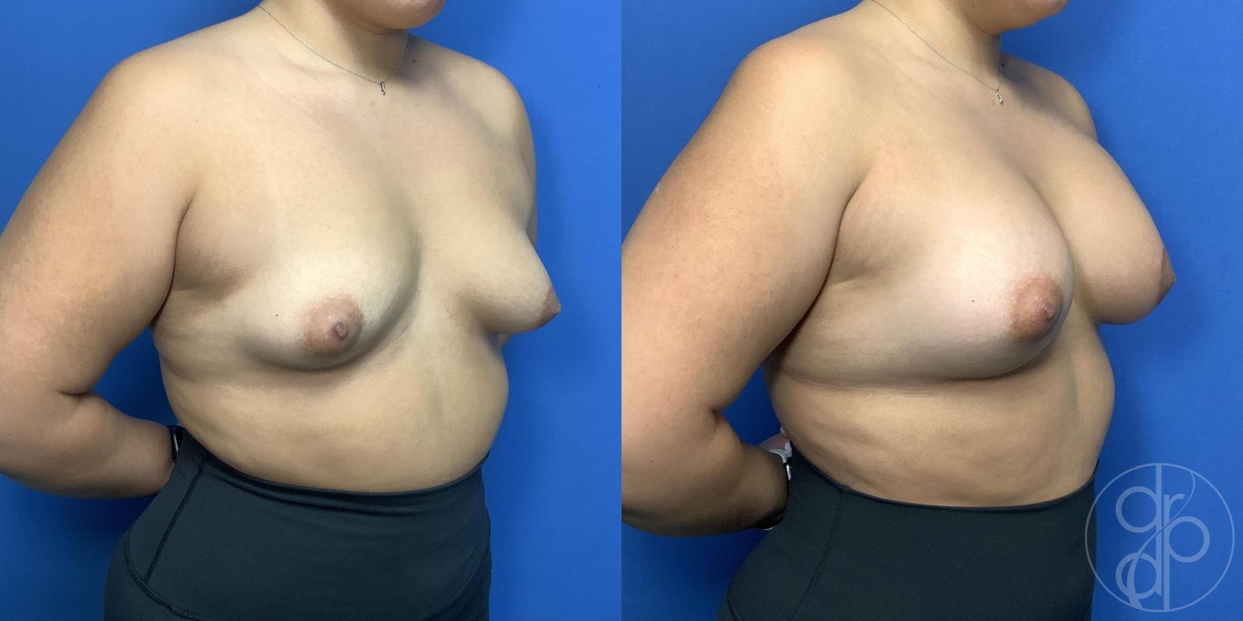 Before and after Tubular Breast Surgery case 29990 - Angle 2