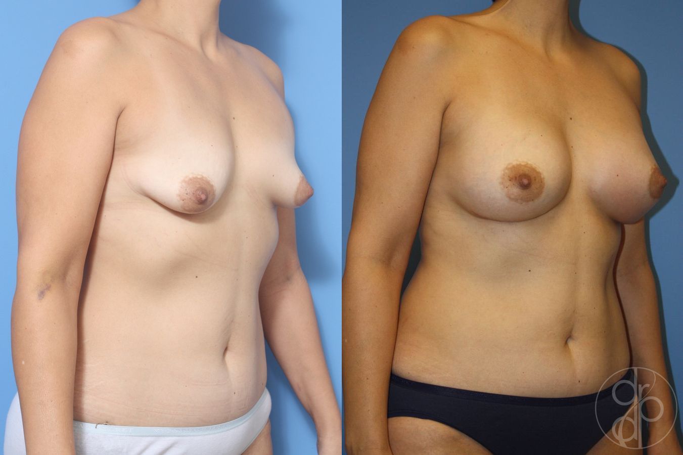 Before and after Tubular Breast Surgery case 29912 - Angle 3