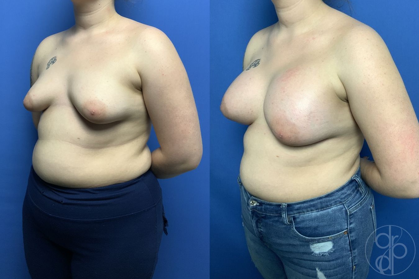 Before and after Tubular Breast Surgery case 29839 - Angle 3