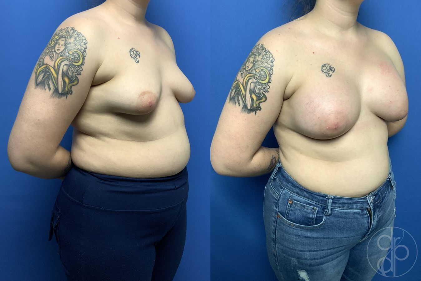 Before and after Tubular Breast Surgery case 29839 - Angle 2