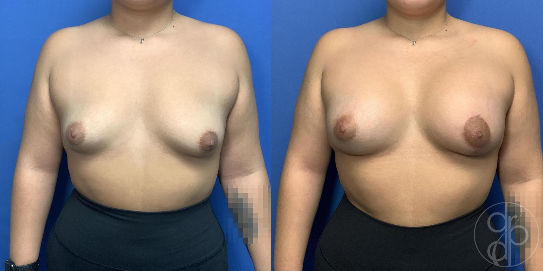 Before and after Tubular Breast Surgery case 29990