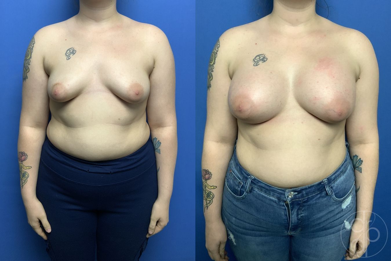 Tubular Breast Surgery - Case 557