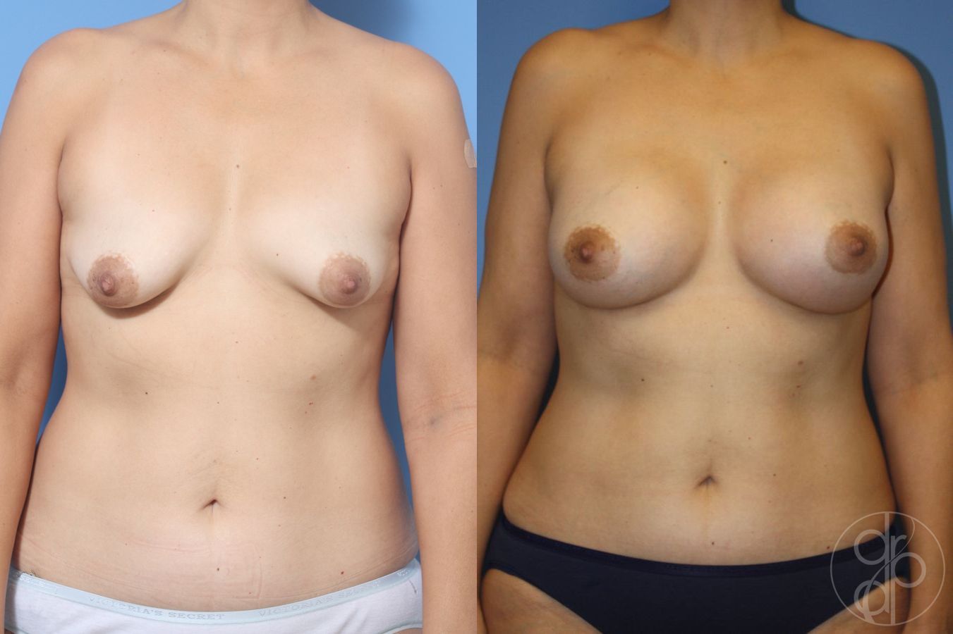Before and after Tubular Breast Surgery case 29912