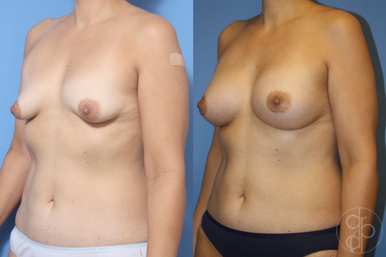 Before and after Tubular Breast Surgery case 29912 - Angle 2