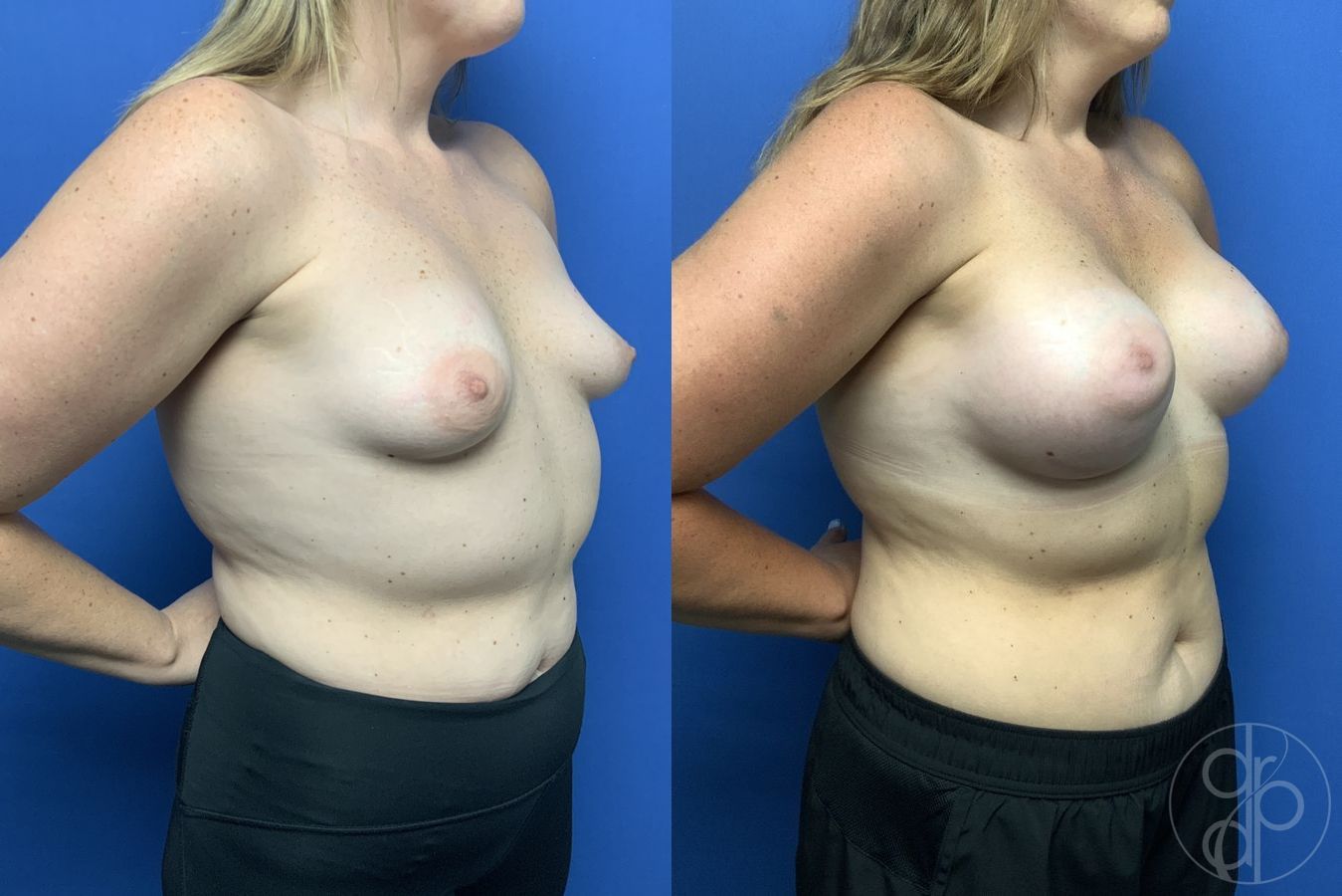 Before and after Tubular Breast Surgery case 29970 - Angle 2