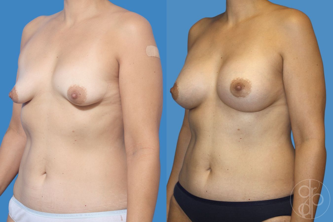 Before and after Tubular Breast Surgery case 29912 - Angle 2
