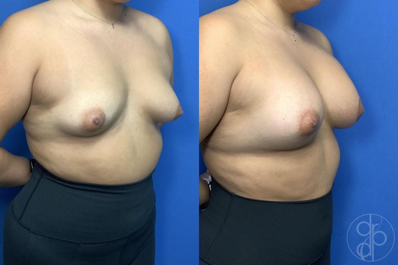 Before and after Tubular Breast Surgery case 29990 - Angle 2