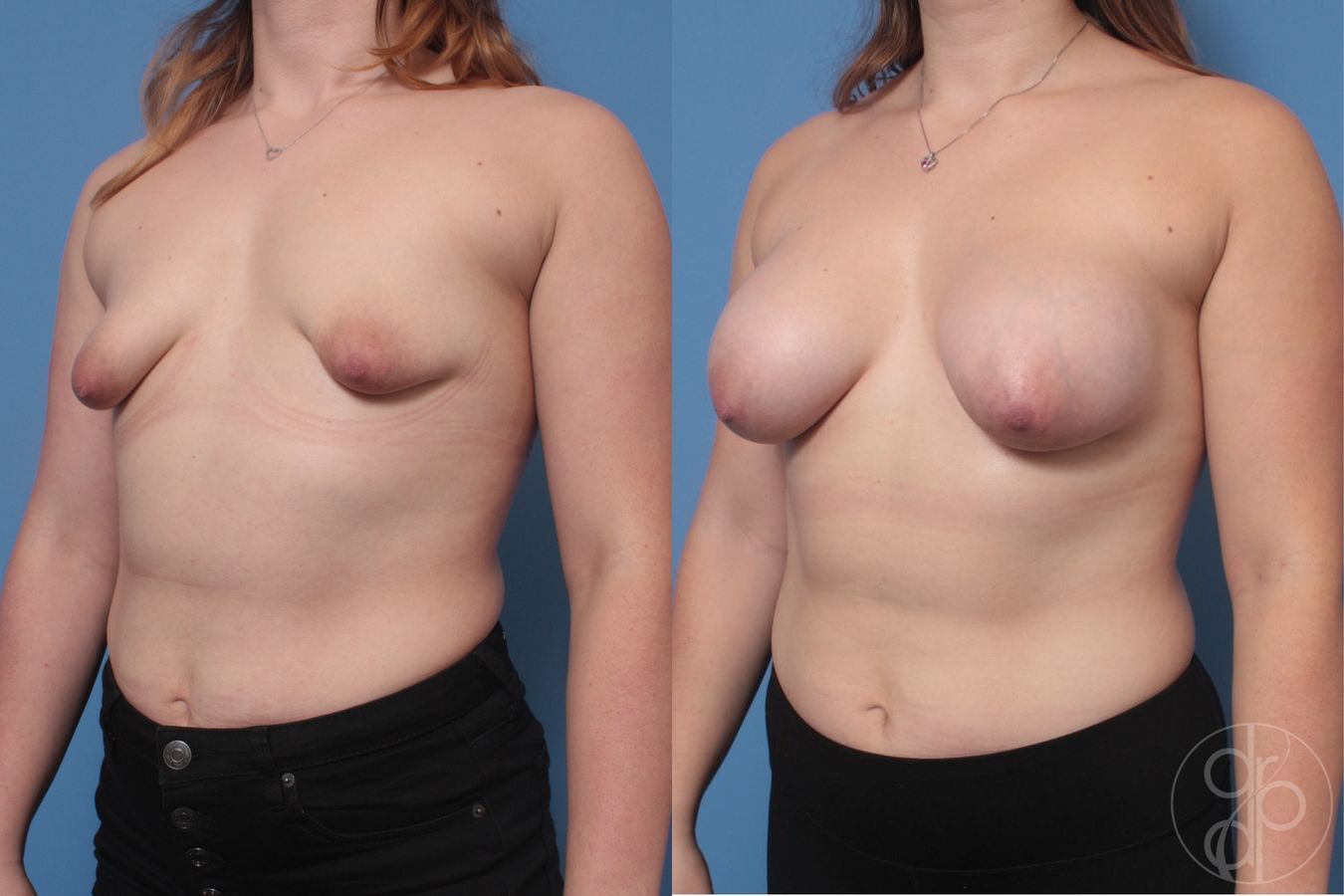 Before and after Tubular Breast Surgery case 29906 - Angle 2