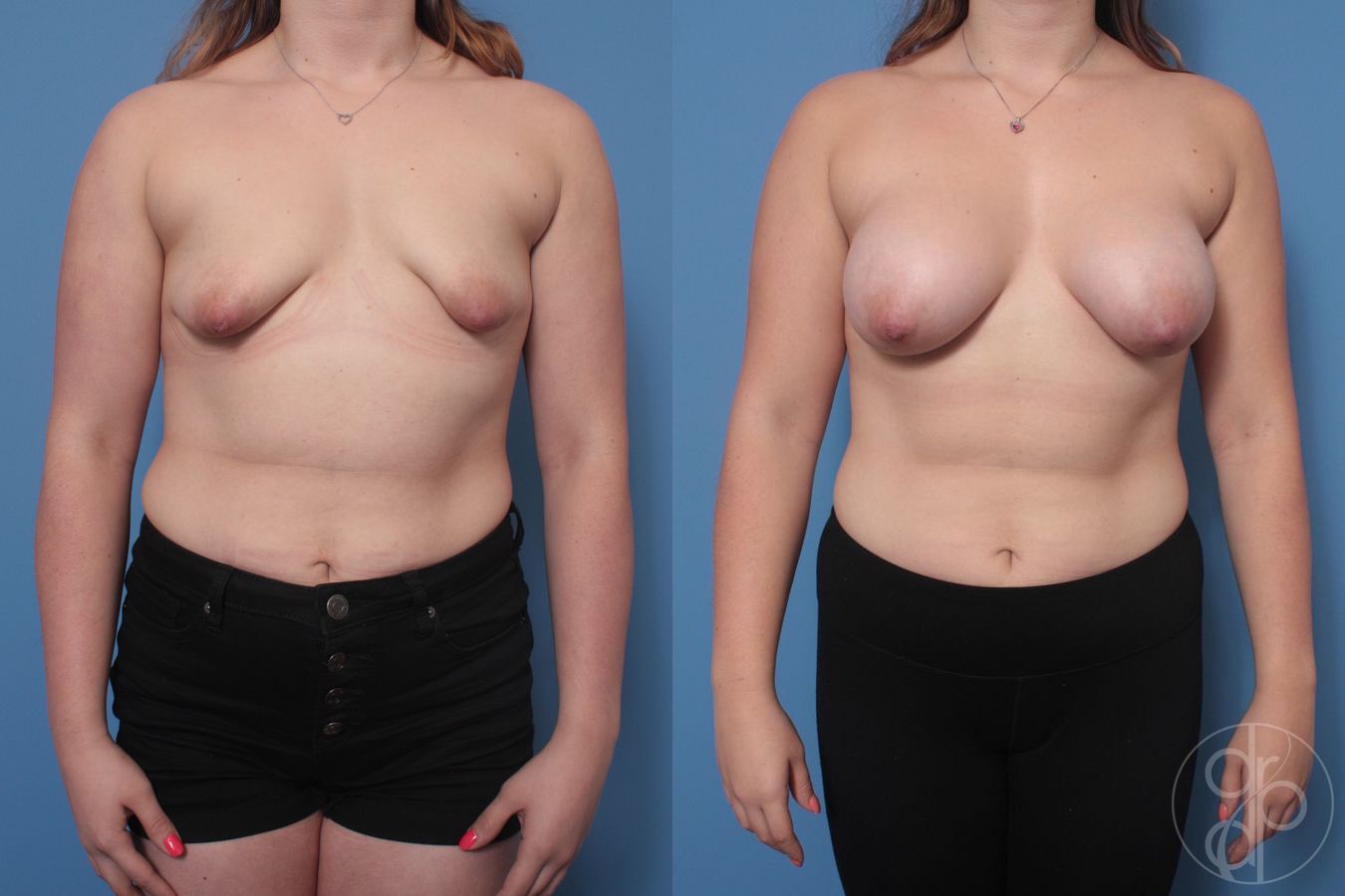 Tubular Breast Surgery - Case 555