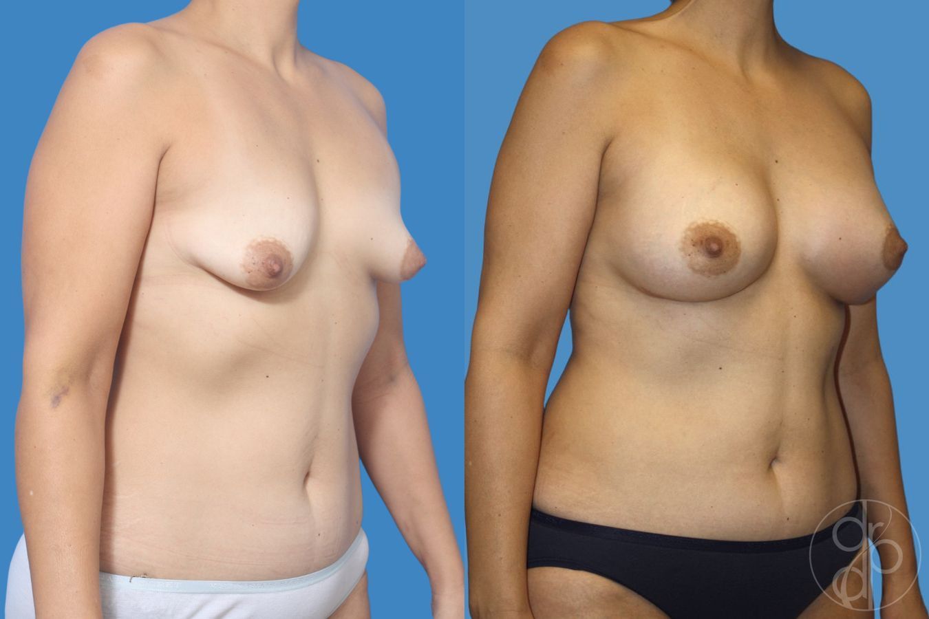 Before and after Tubular Breast Surgery case 29912 - Angle 3