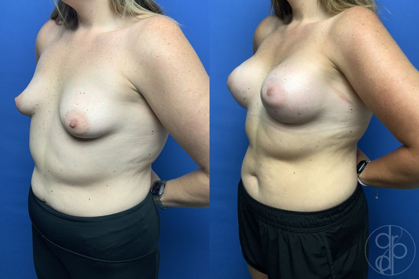 Before and after Tubular Breast Surgery case 29970 - Angle 3
