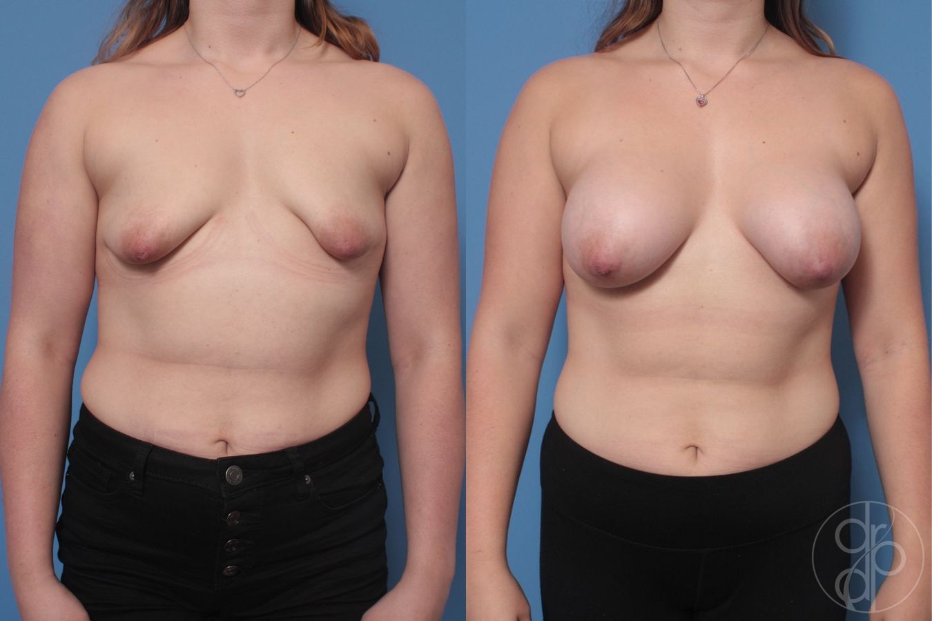 Before and after Tubular Breast Surgery case 29906