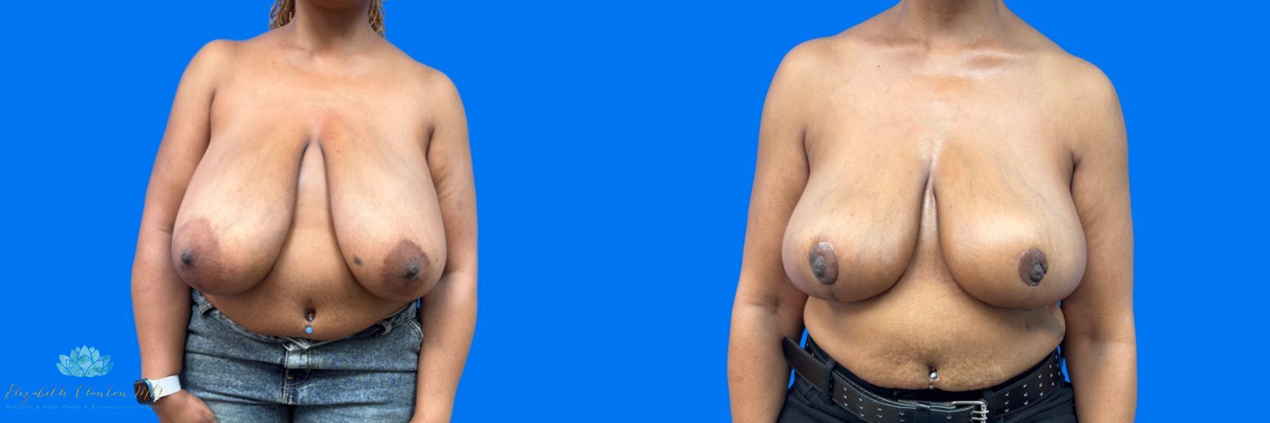Before and after Bilateral Breast Reduction case 41365