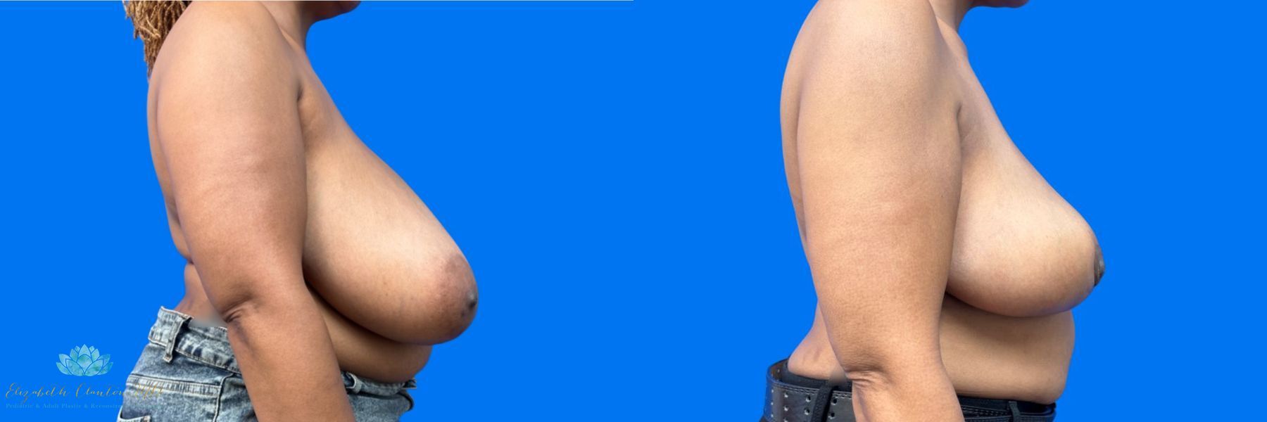 Before and after Bilateral Breast Reduction case 41365 - Angle 2