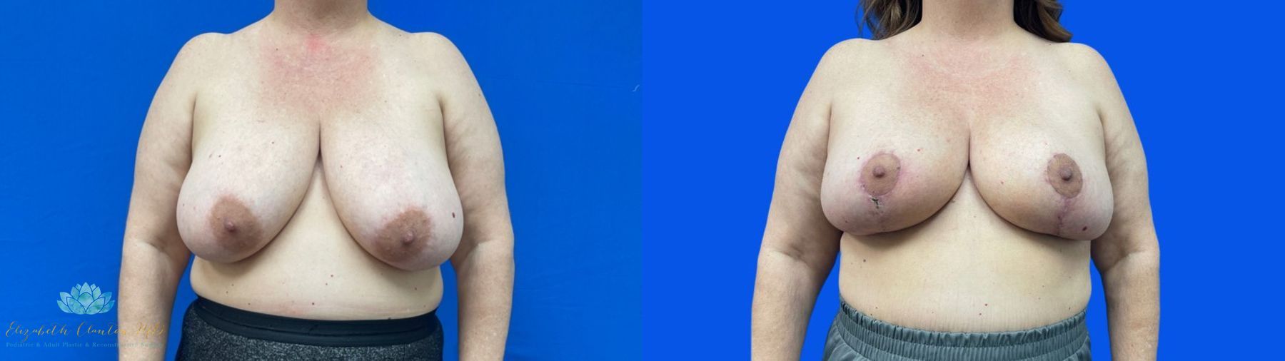Before and after Bilateral Breast Reduction case 41367