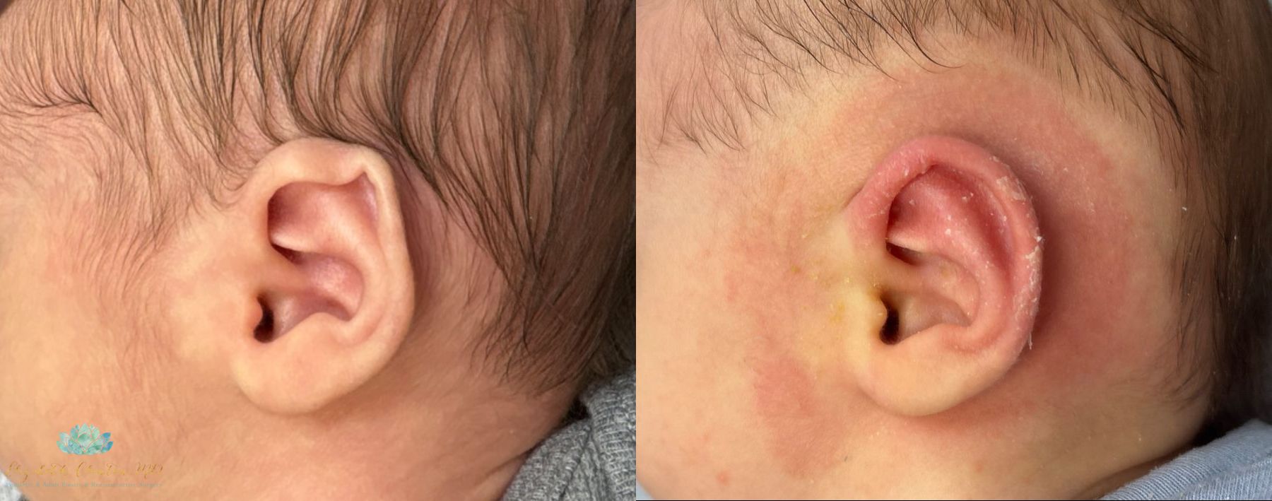 Before and after Earwell case 41353