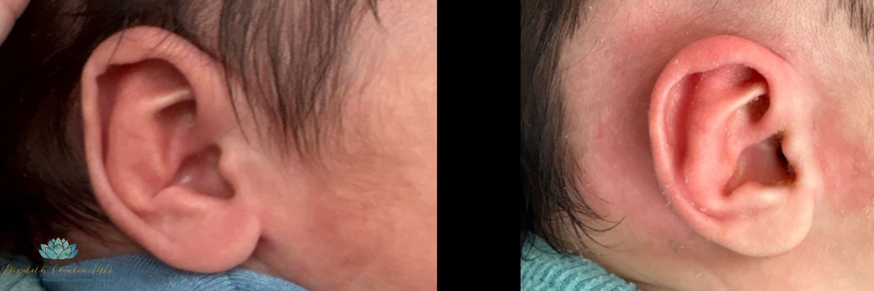 Before and after Earwell case 41352