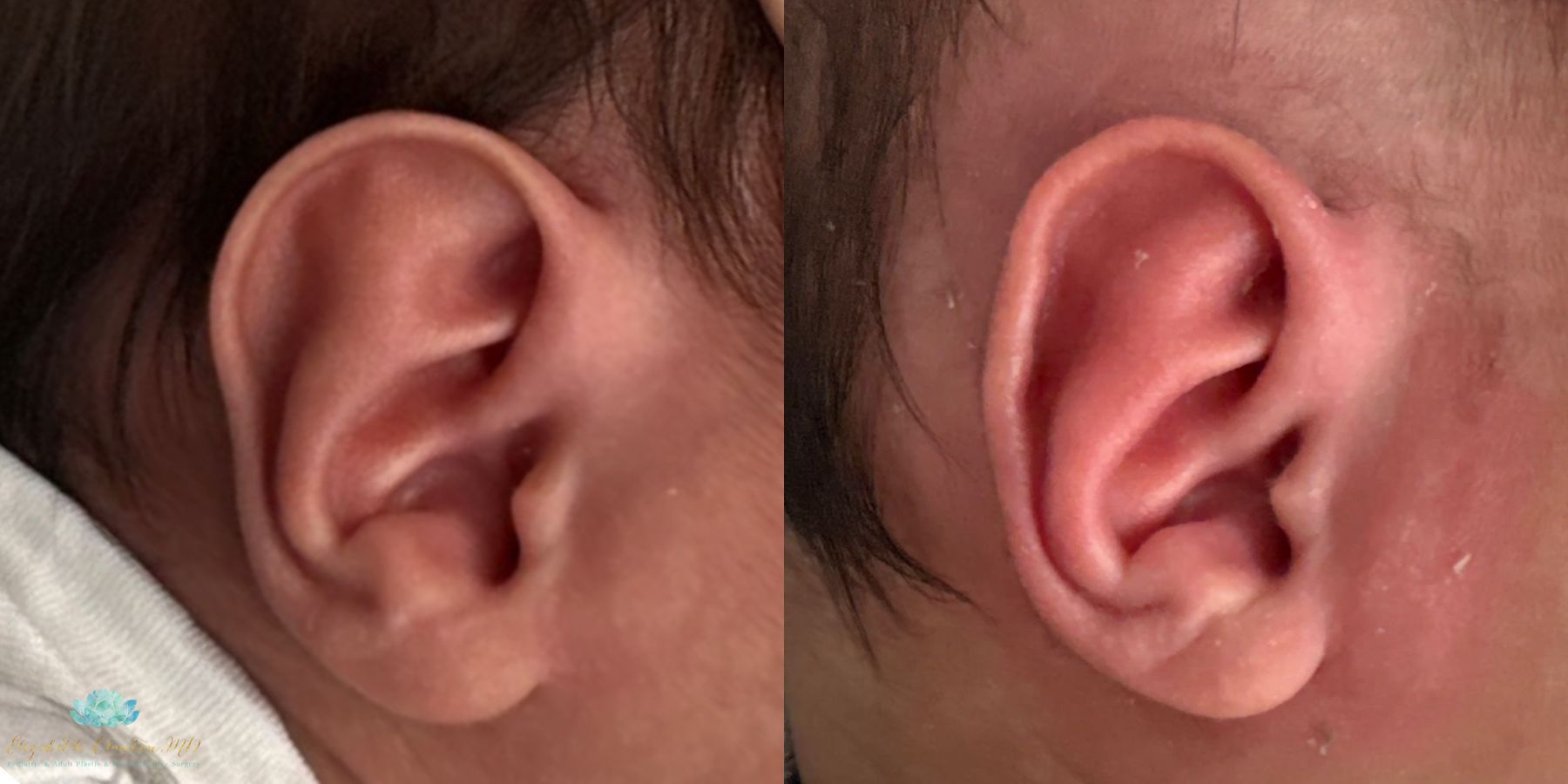 Before and after Earwell case 41355