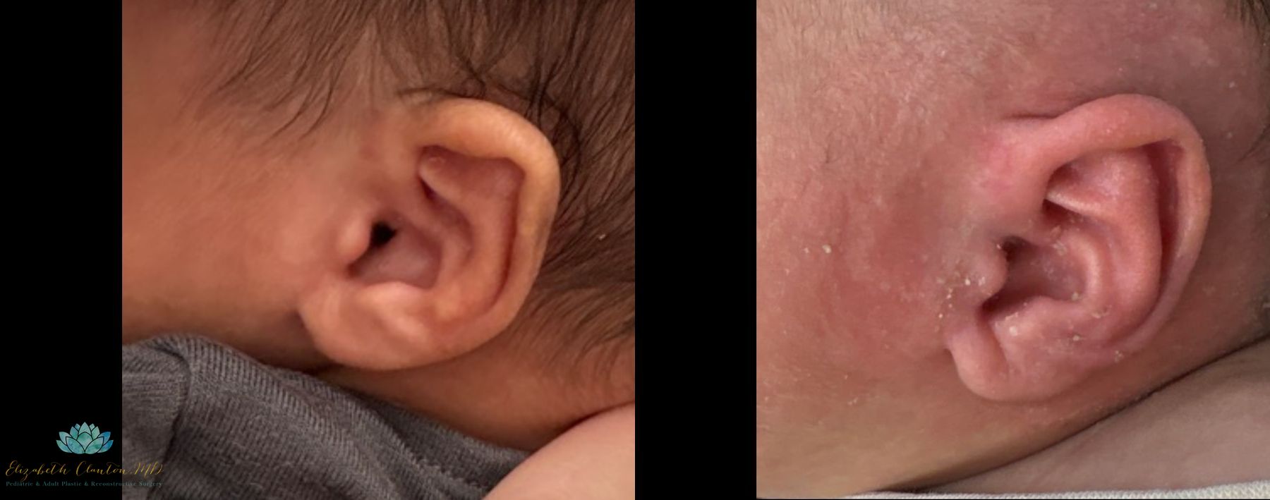 Before and after Earwell case 41334