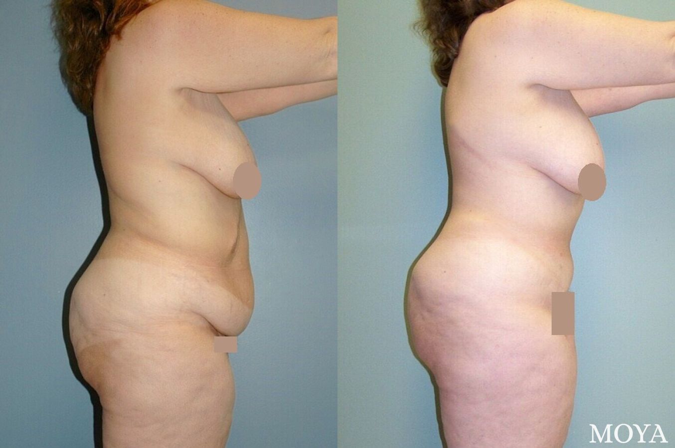 Before and after Corset Body Lift® case 39193 - Angle 2