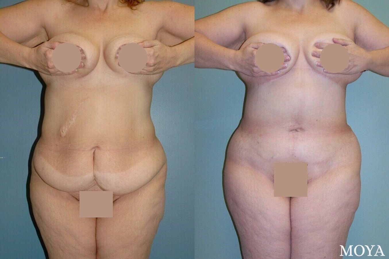 Before and after Corset Body Lift® case 39193